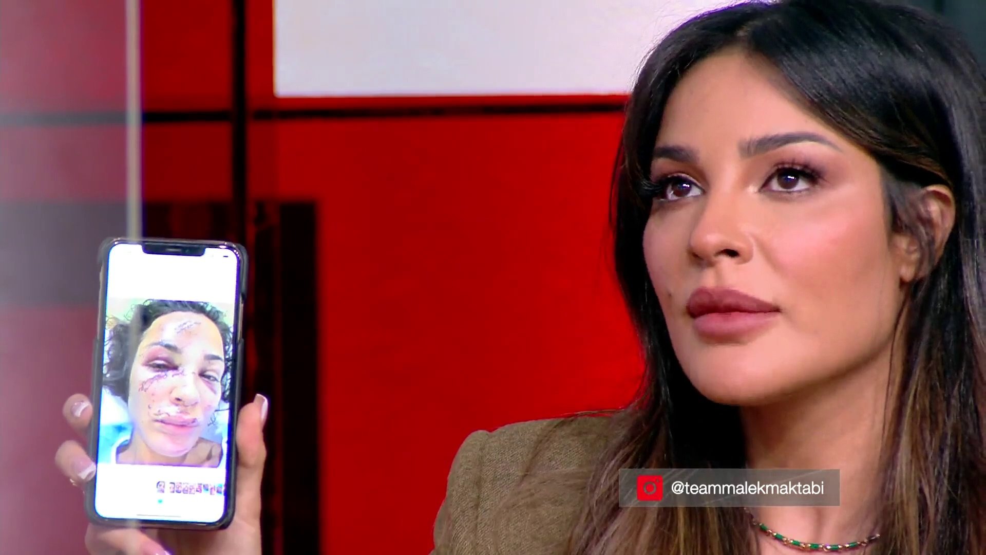 نادين نجيم تتقاسم مع جمهورها صور جروح وجهها في انفجار مرفأ بيروت