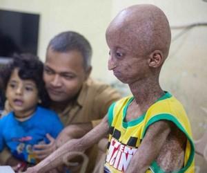 بالصور: مراهق يعيش في جسد عجوز 1444333825_2_1