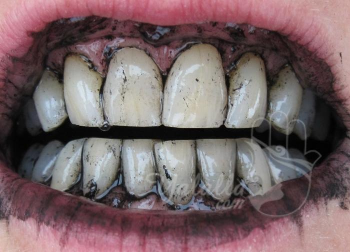 الوصفة الصحية لتبييض الأسنان بالفحم