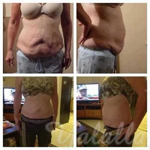 stomach_before_after17_10_wraps_