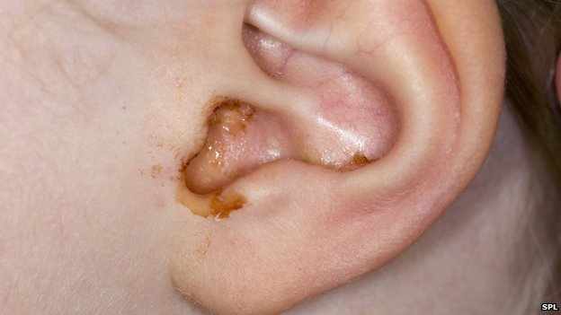 هكذا تزيلون المادة الشمعية المتراكمة في الأذن و التي تسبب لكم الألم و ضعف السمع