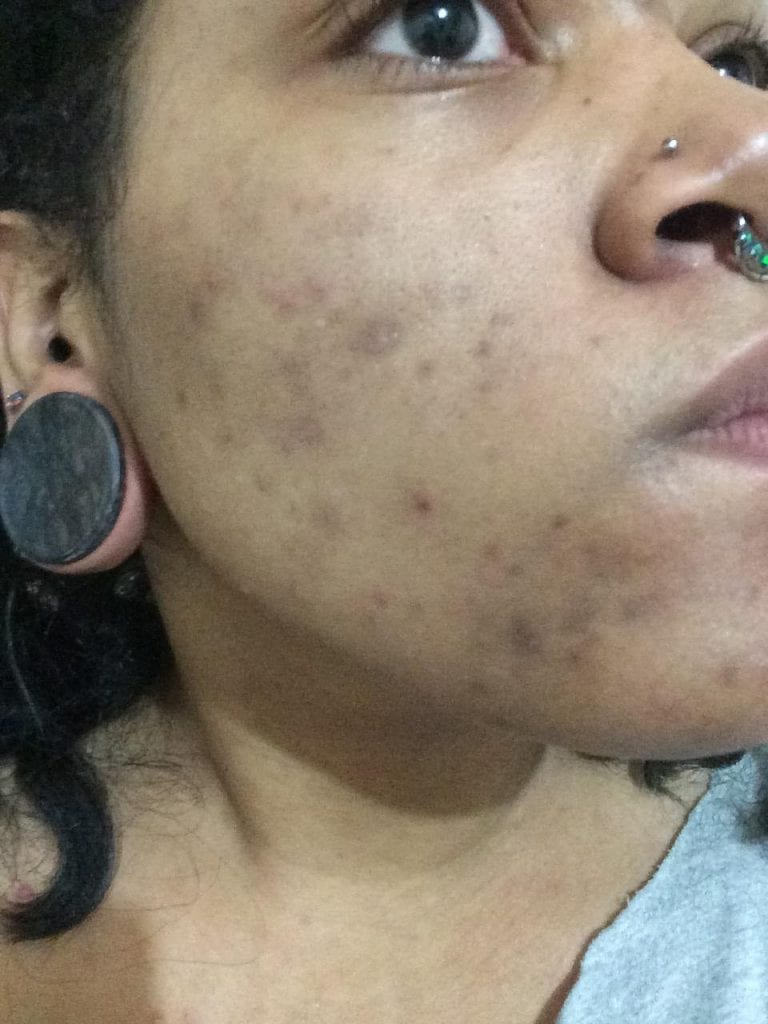 acne(1)