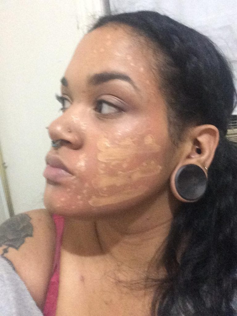 acne(8)