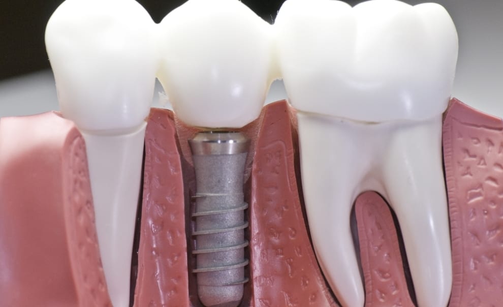 عملية زرع الأسنان:مدتها و مراحلها المفصلة و هل يستجيب لها الجسم دائما؟؟