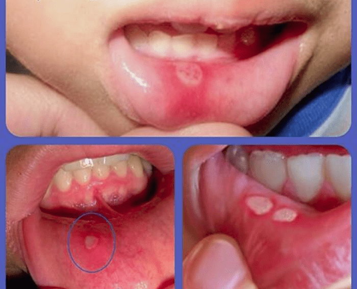 علاج قرح الفم التي تظهر بهذا الشكل في ساعتين فقط ولا تقلق منها مرة اخرى