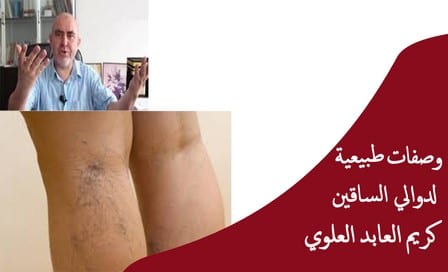 لا مزيد من المعاناة مع دوالي الساقين...العلاج الطبيعي الناجح 100% من الدكتور كريم عابد العلوي