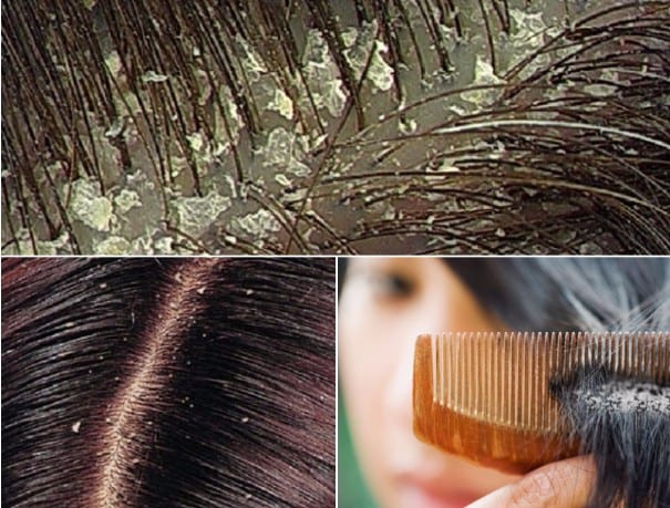 سفير العنب لعنة  فرشاة النساء نزول طريقة للتخلص من قشرة الشعر - mpcollegedanta.org