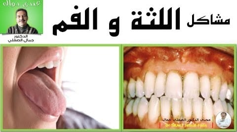 وصفة الدكتور جمال الصقلي الخيالية لازالة اصفرار الاسنان و علاج تقرحات الفم و الميكروبات