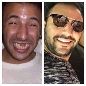 بالصور.. مشاهير مغاربة قبل وبعد ابتسامة “هوليوود سمايل”