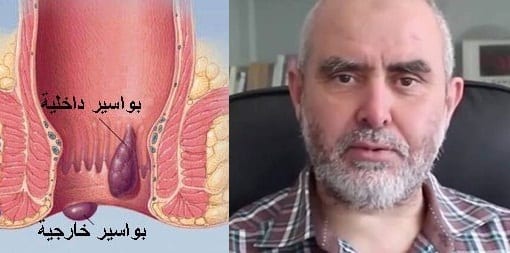 أخيرا....علاج البواسير داخلياً و خارجياً بطرق طبيعية سهلة مع الدكتور كريم عابد العلوي!!