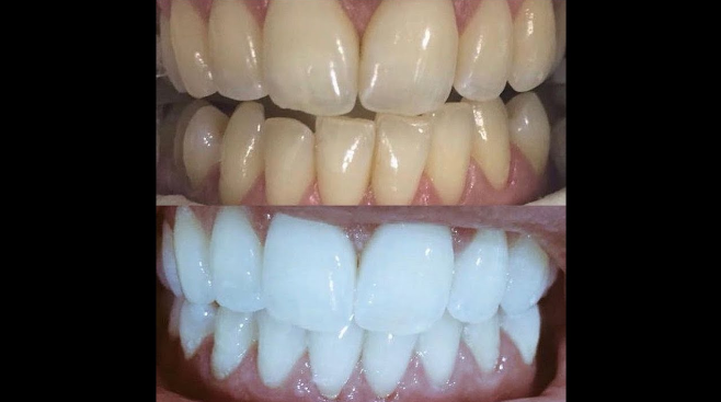 ملعقة من هذا المكون الرخيص معجزة في ازالة الكالكيرو اصفرار الاسنان في 3 دقائق