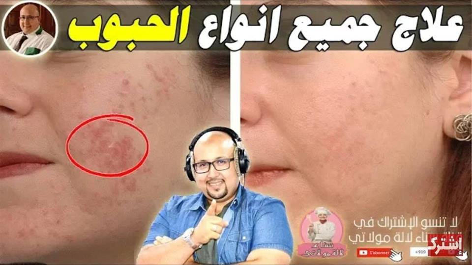 لي فيها الجبوب وسيكاتريس تجرب الوصفة لي نصح بها الدكتور عماد ميزاب كاع الناس شكروها