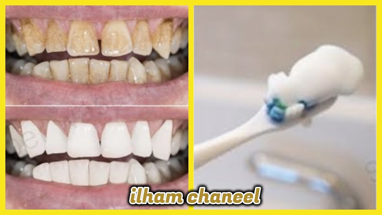 في دقيقتين اسنانك الصفراء ستصبح بيضاء تلمع خالية من الجير بدون طبيب