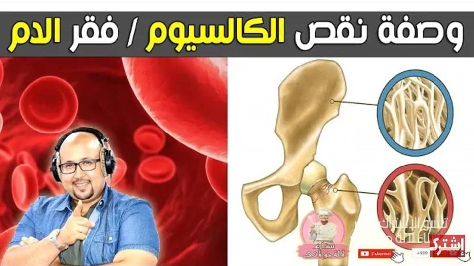 تجربتي مع نقص الكالسيوم