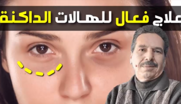 وصفة صاروخية لعلاج الهالات السوداء حول العينين مع الدكتور جمال الصقلي