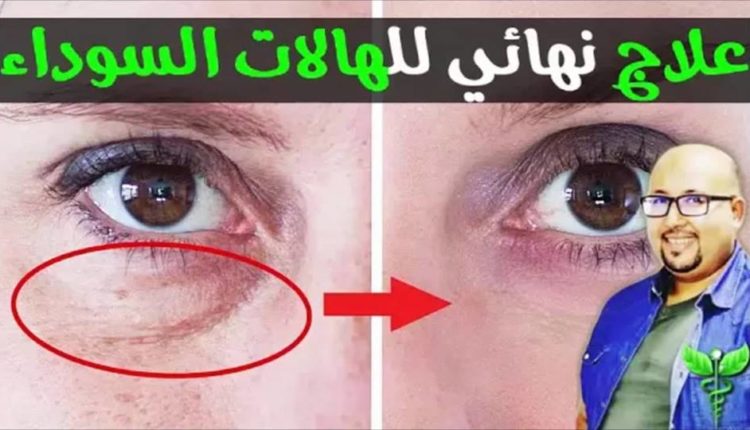 علاج نهائي للهالات السوداء ومشكلة البشرة المحيطة بالعين مع الدكتور عماد ميزاب