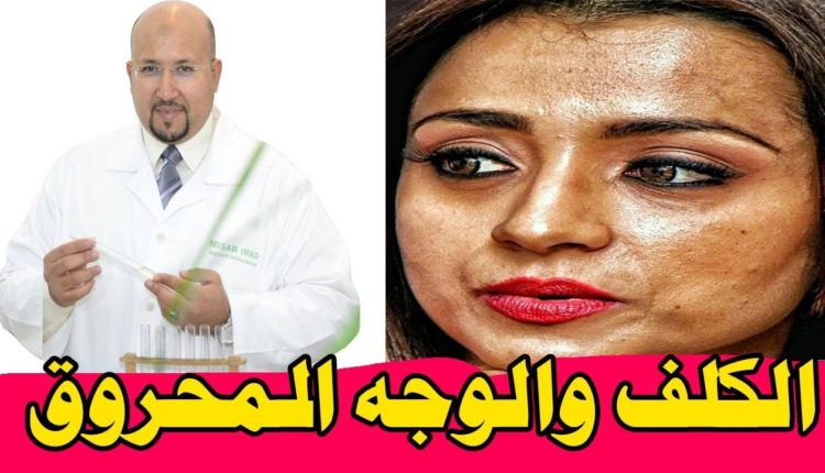 الدكتور عماد ميزاب ينصح السيدات بهذه الطريقة الوحيدة لعلاج الوجه المحروق بالكريمات و الكلف