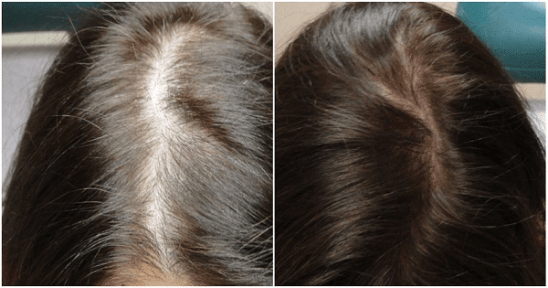 وصفة زيت جوز الهند و الثوم لانبات الشعر في مقدمة الرأس